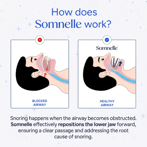 Somnelle Anti Snore Mouthpiece